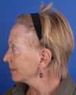 After Hair Transplant&nbsp;Hair Thinning